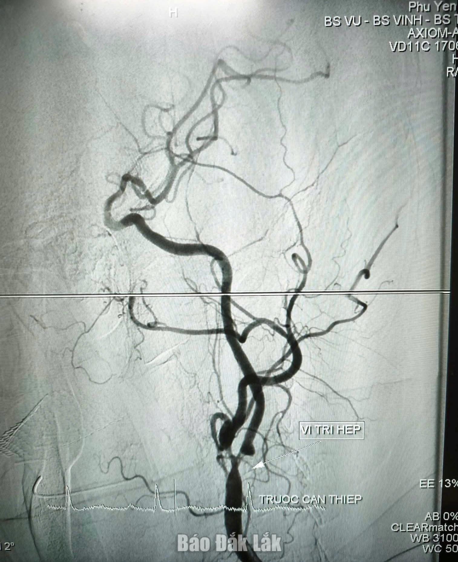 Bệnh viện Đa khoa Phú Yên thực hiện thành công kỹ thuật đặt stent động mạch cảnh 2 th