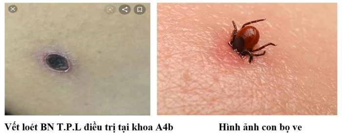 Không chủ quan với bệnh sốt mò